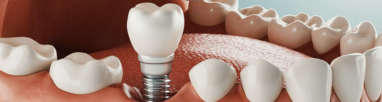 The Procedure - Dental Implants