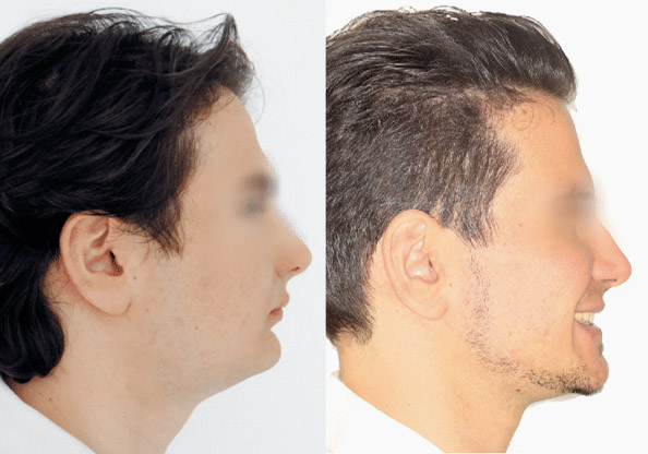 Orthognathic Surgery - Before and After Transformation