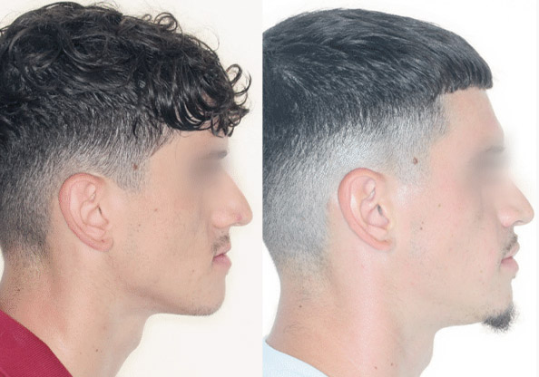 Orthognathic Surgery - Before and After Transformation